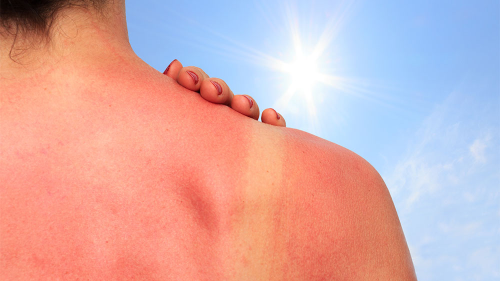 blauwasser_medizin_segeln_sonnenschutz_sonnenbrand